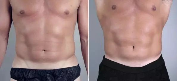 Sadaya Anu Anjeun Kedah Apal Ngeunaan Liposuction di Budapest 55363_2