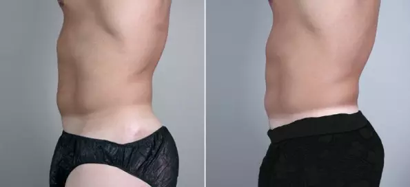 Ang Kailangan Mong Malaman Tungkol sa Liposuction sa Budapest 55363_3