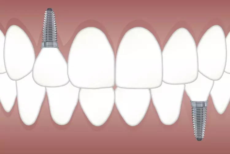 Implantes dentales y su importancia para usted 8116_4